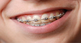 metal braces traditional braces