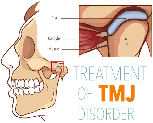 TMJ Problems